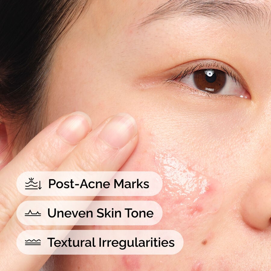 The Ordinary Blemish Solution with Aloe 2% and NAG 2% | Item Overview　Me