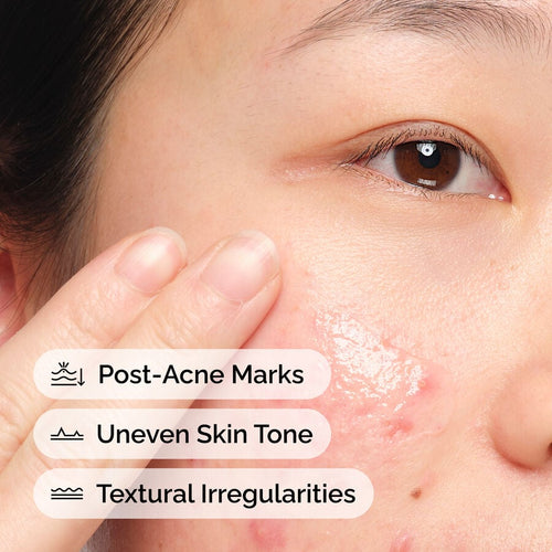 The Ordinary Blemish Solution with Aloe 2% and NAG 2% | Item Overview　Me