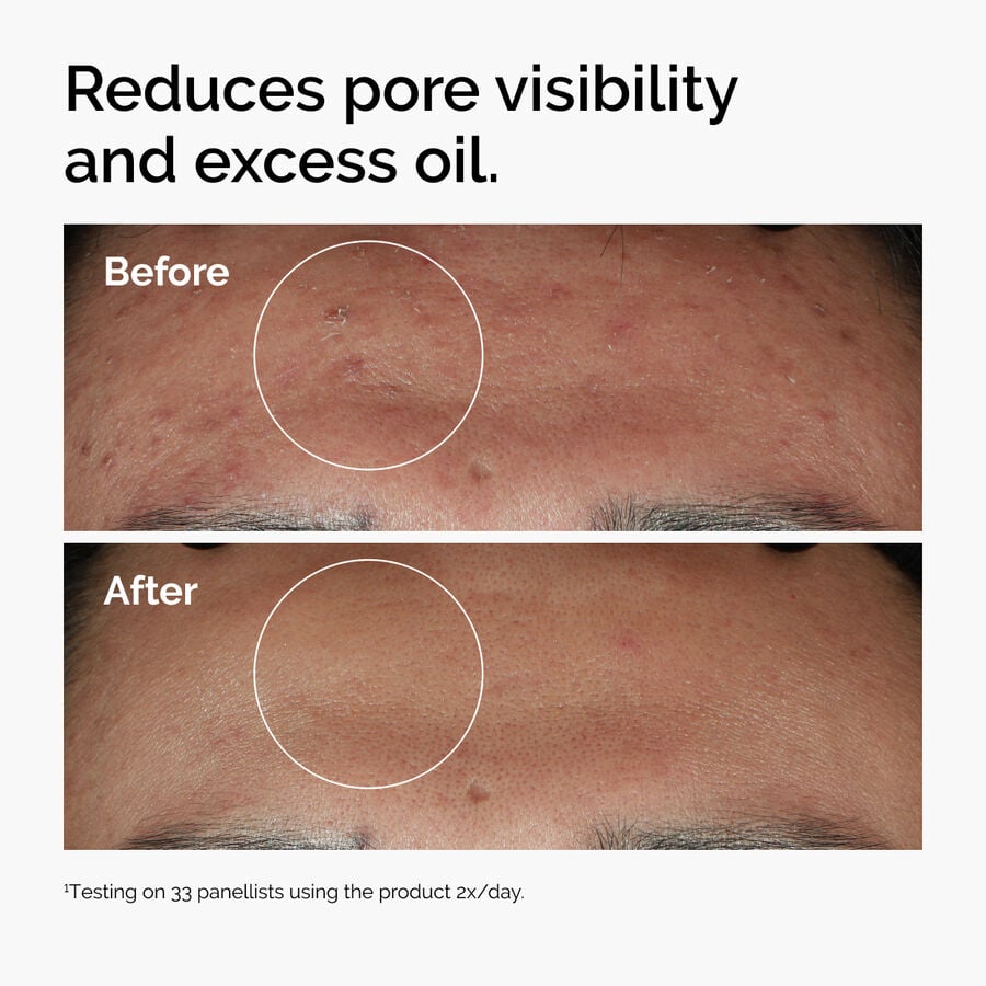 The Ordinary Treatment - Niacinamide 10% + Zinc 1% | Detailed Overview　5I