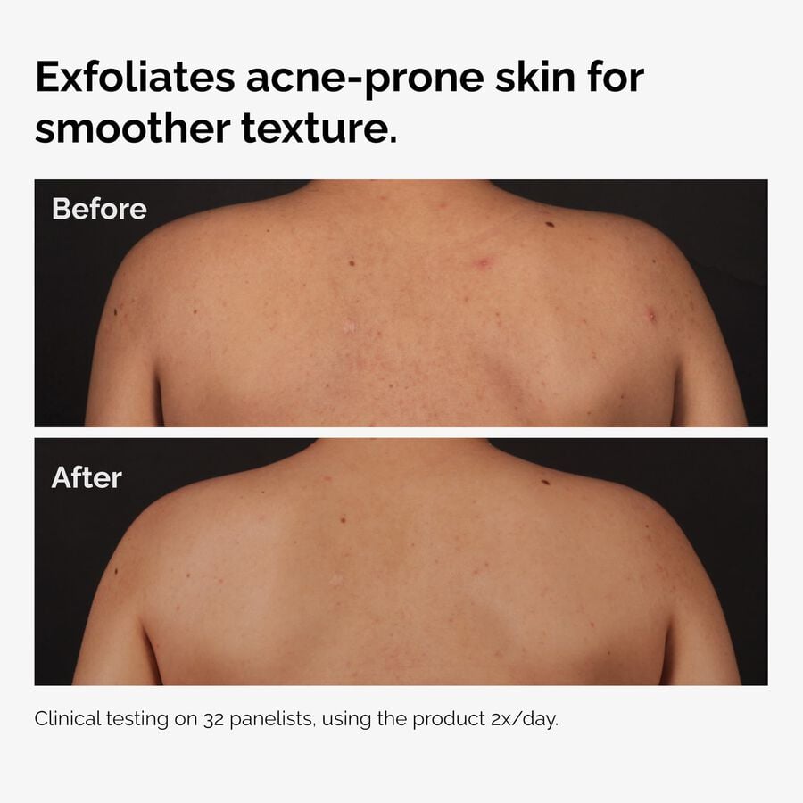 The Ordinary Body Care Treatment - Salicylic Acid 0.5% Body Serum | Product Features　3h