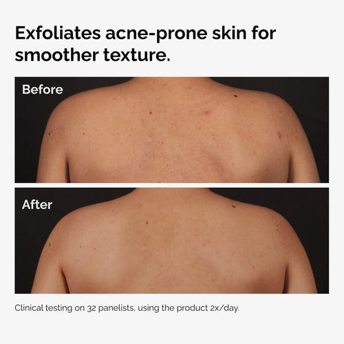 The Ordinary Body Care Treatment - Salicylic Acid 0.5% Body Serum | Product Features　3h